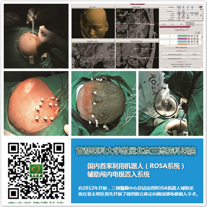 机械人无框架立体定向脑深部电极置入手术